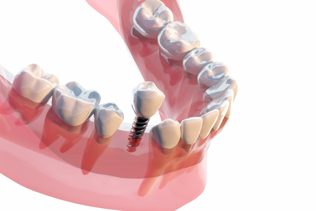 向ヶ丘遊園、登戸の歯医者、近藤歯科でインプラント治療