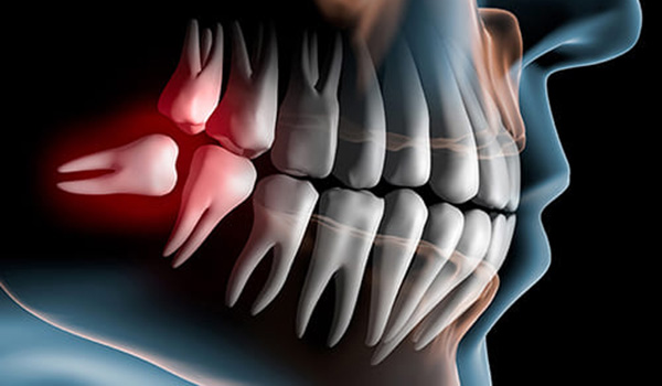 向ヶ丘遊園、登戸の歯医者、近藤歯科で親知らずの抜歯
