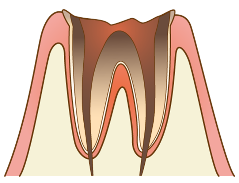 向ヶ丘遊園、登戸の歯医者、近藤歯科のMI治療