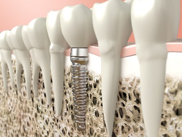 向ヶ丘遊園、登戸の歯医者、近藤歯科のインプラント治療