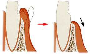 向ヶ丘遊園、登戸の歯医者、近藤歯科の歯冠長延長術（クラウンレングスニング）