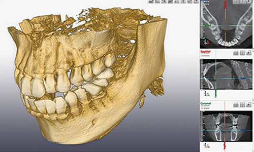 向ヶ丘遊園、登戸の歯医者、近藤歯科のＣＴによる精密分析