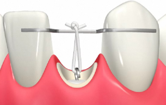 向ヶ丘遊園、登戸の歯医者、近藤歯科の矯正的挺出（エキストルージョン）