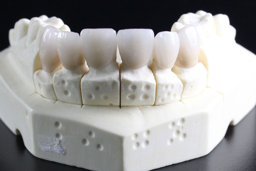 向ヶ丘遊園、登戸の歯医者、近藤歯科で即日セレック(CEREC)治療