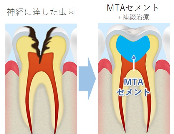 向ヶ丘遊園、登戸の歯医者、近藤歯科のMTAセメント