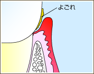向ヶ丘遊園、登戸の歯医者、近藤歯科で歯周病治療