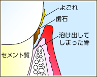 向ヶ丘遊園、登戸の歯医者、近藤歯科で歯周病治療