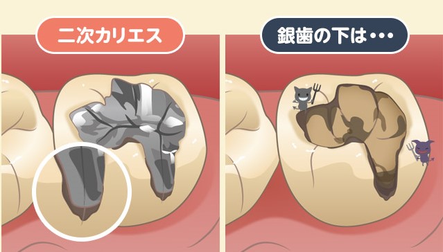 向ヶ丘遊園、登戸の歯医者、近藤歯科で虫歯治