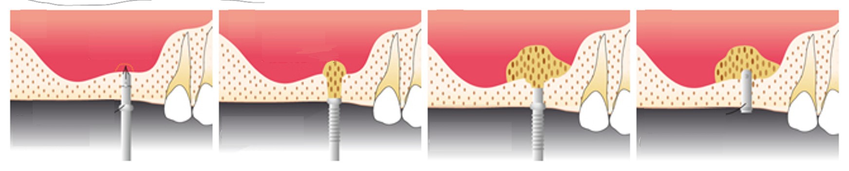 向ヶ丘遊園、登戸の歯医者、近藤歯科でインプラント