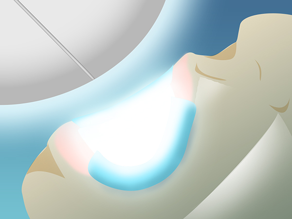 向ヶ丘遊園、登戸の歯医者、近藤歯科でホワイトニング